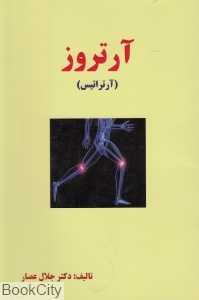 آرتروز